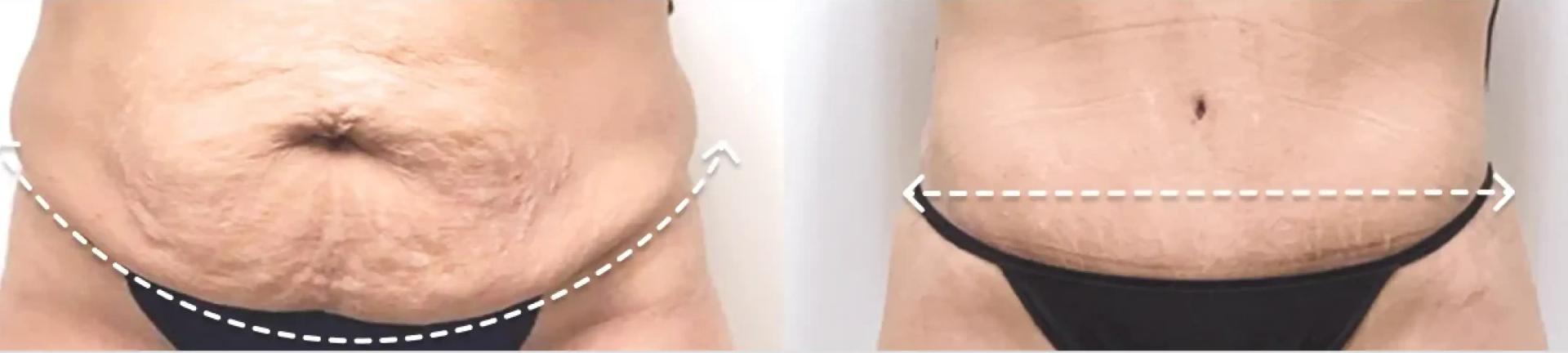 Abdominoplasty