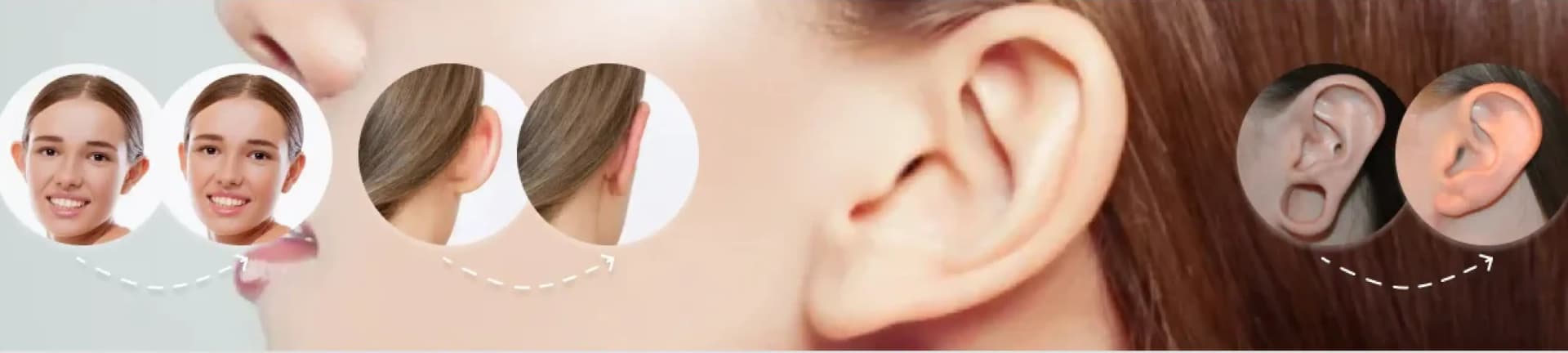 Otoplasty