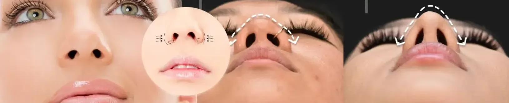 Alarplasty