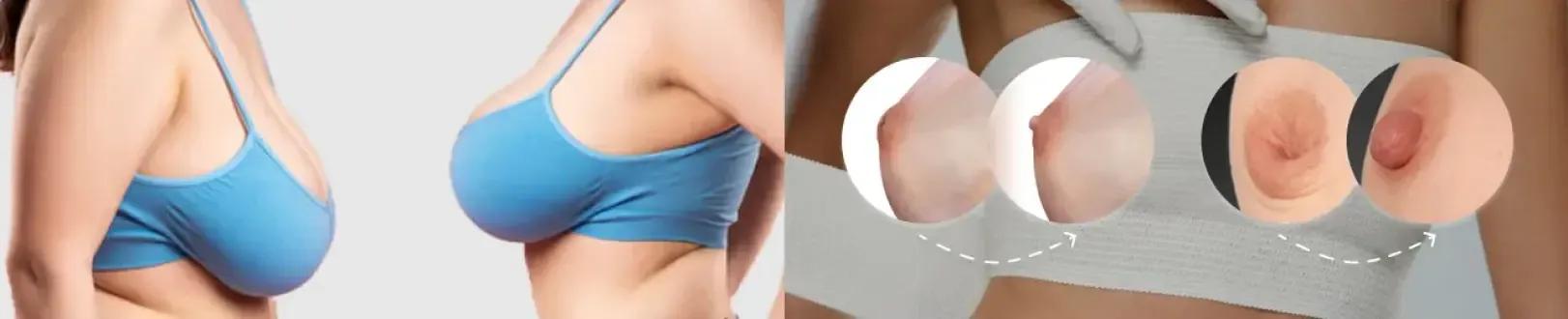 Breast Lift
