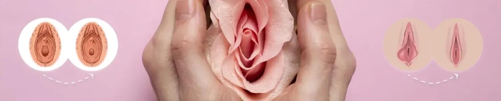 Vaginoplasty