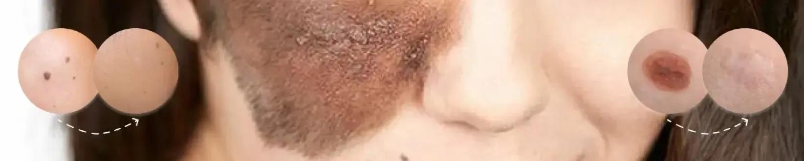 Excision Nevus