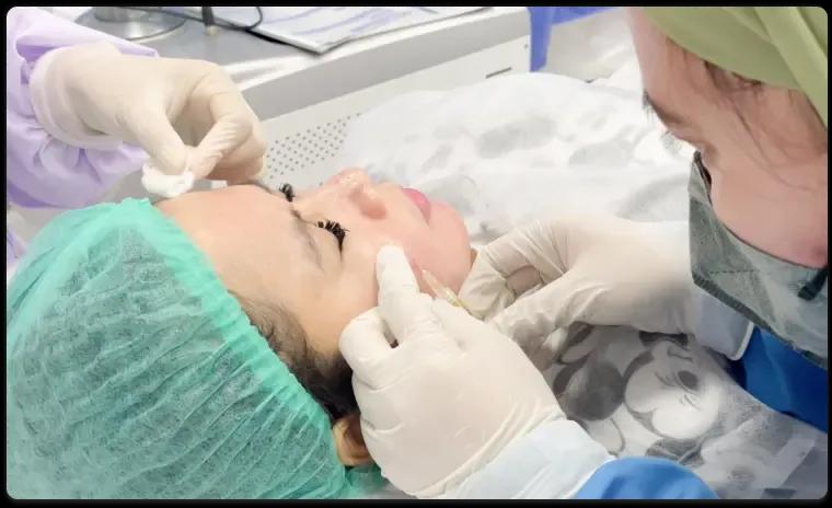 Platelet Rich Plasma (PRP) with Subcision