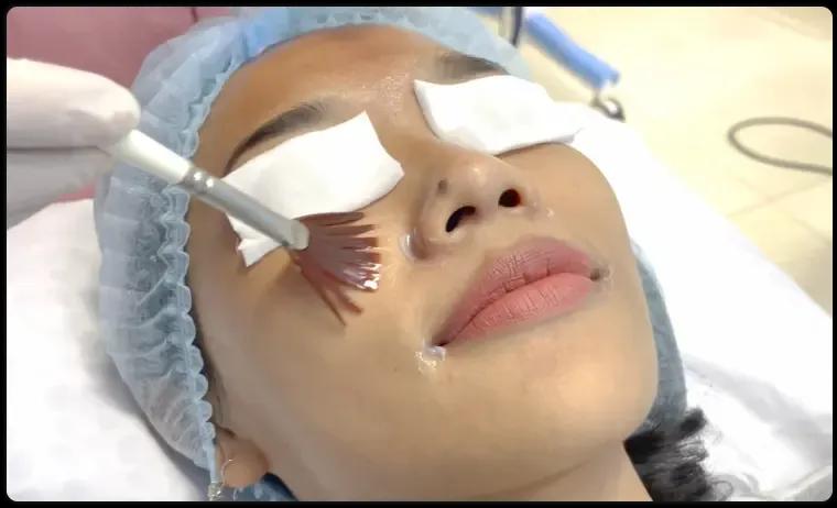 Skin Peeling